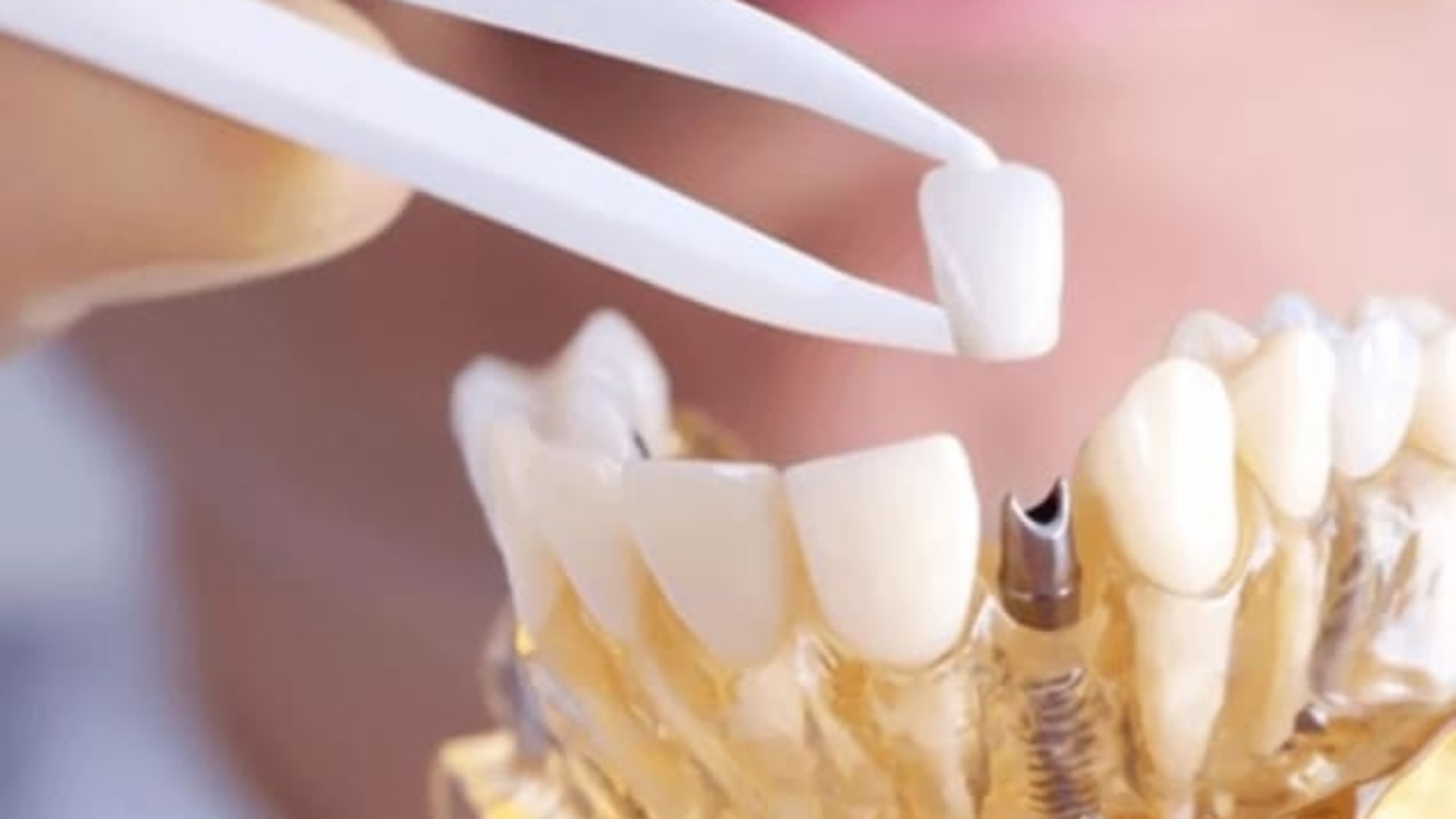 Custo implante dentário
