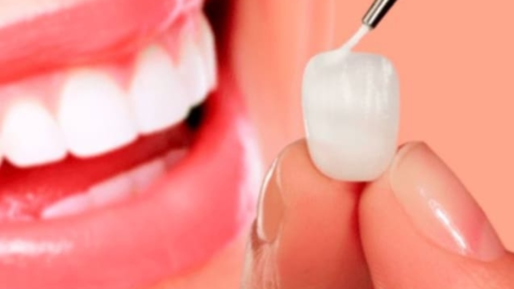 Lente de contato dental em Salvador